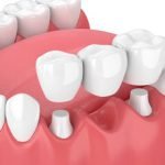 Ceramic Crowns and Bridges Fixing