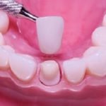 Fixed Prosthodontics
