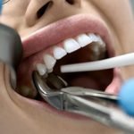 Surgical Tooth Extraction